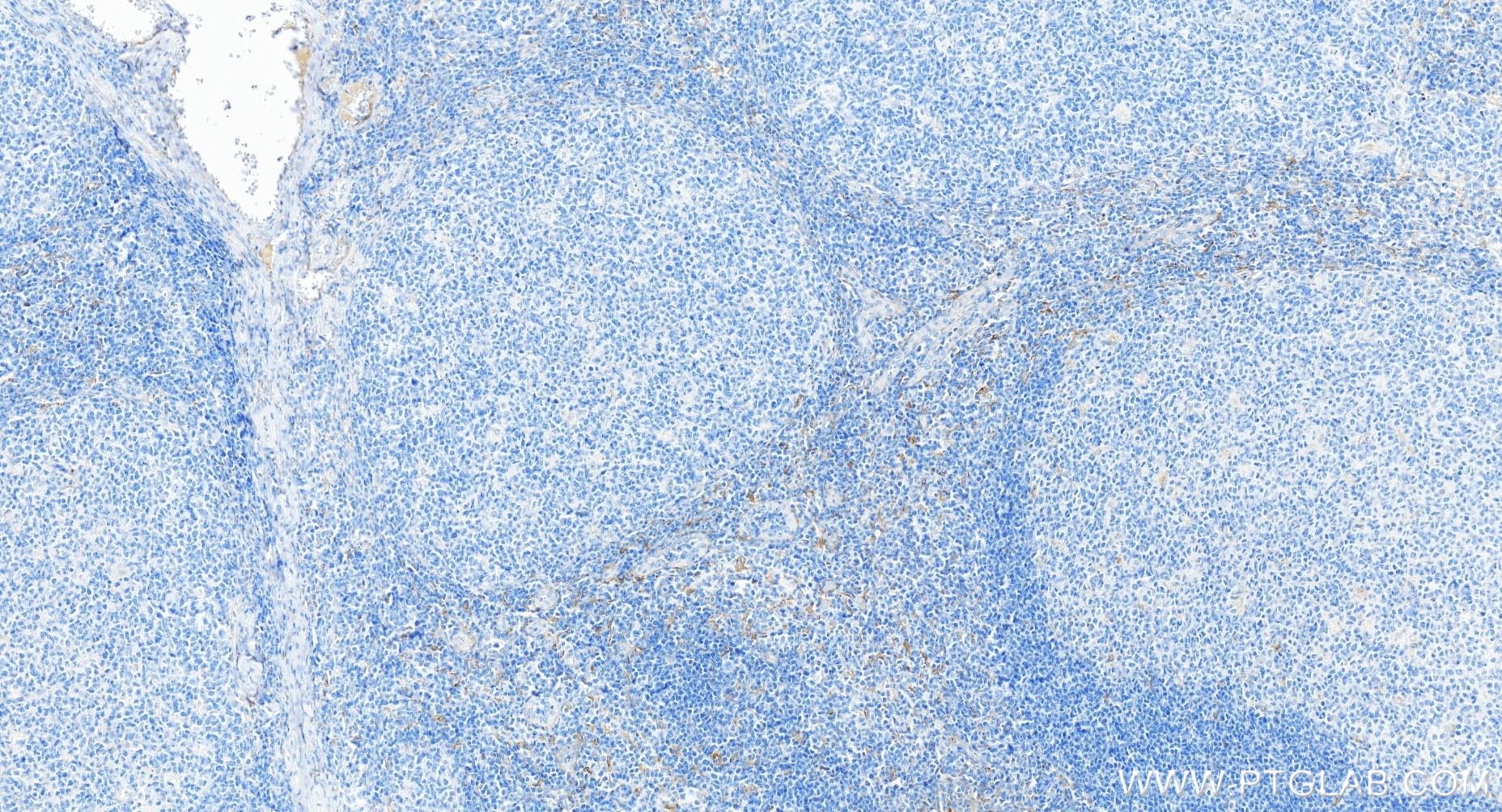 Immunohistochemistry (IHC) staining of human tonsillitis tissue using CSF1R/CD115 Recombinant monoclonal antibody (84477-6-RR)