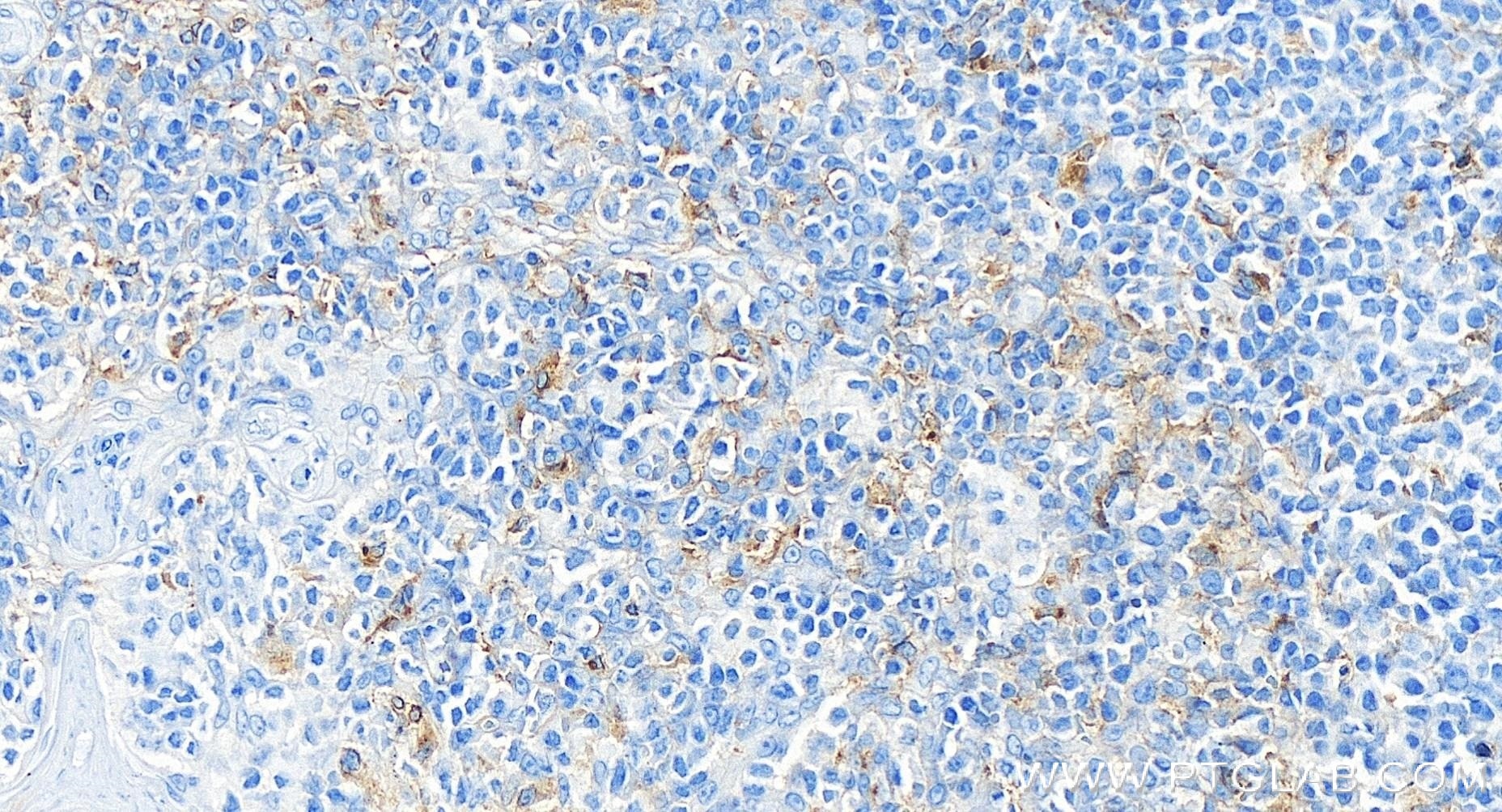 Immunohistochemistry (IHC) staining of human tonsillitis tissue using CSF1R/CD115 Recombinant monoclonal antibody (84477-6-RR)