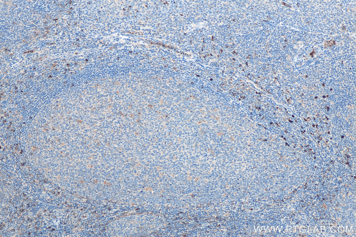 Immunohistochemistry (IHC) staining of human tonsillitis tissue using GM-CSF Polyclonal antibody (17762-1-AP)