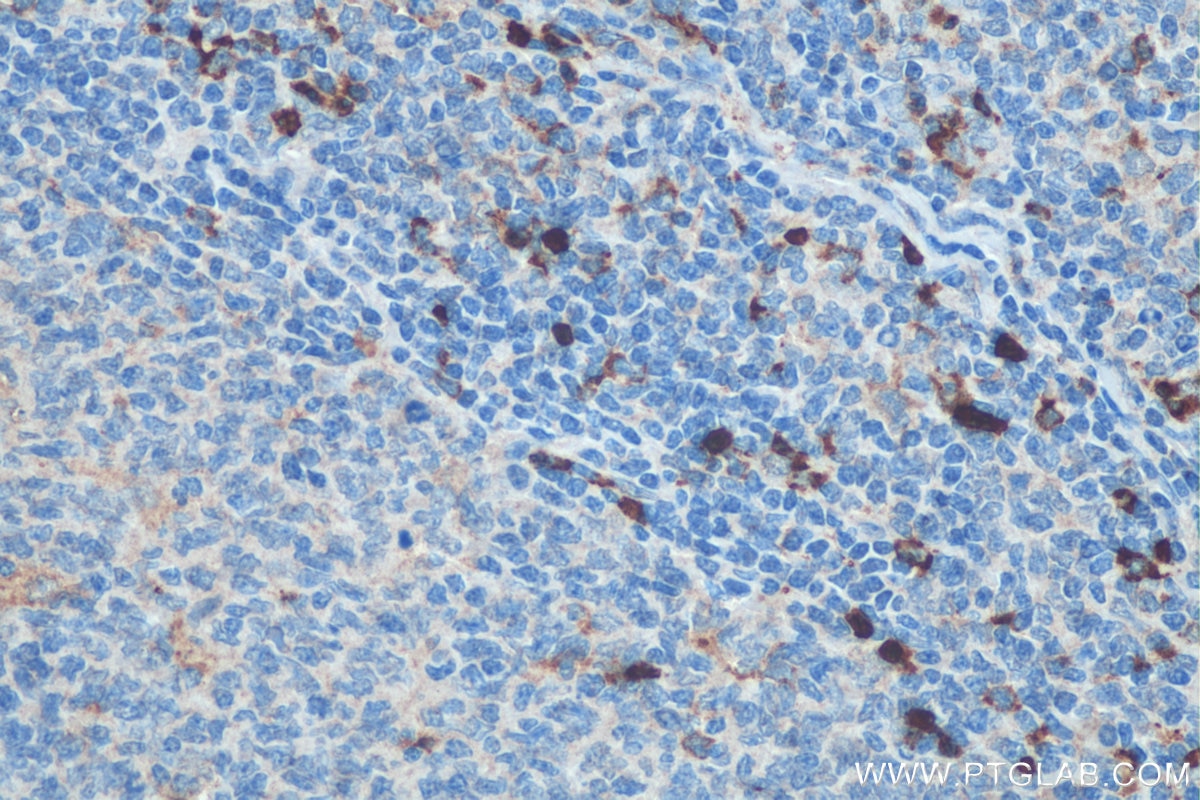 Immunohistochemistry (IHC) staining of human tonsillitis tissue using GM-CSF Polyclonal antibody (17762-1-AP)