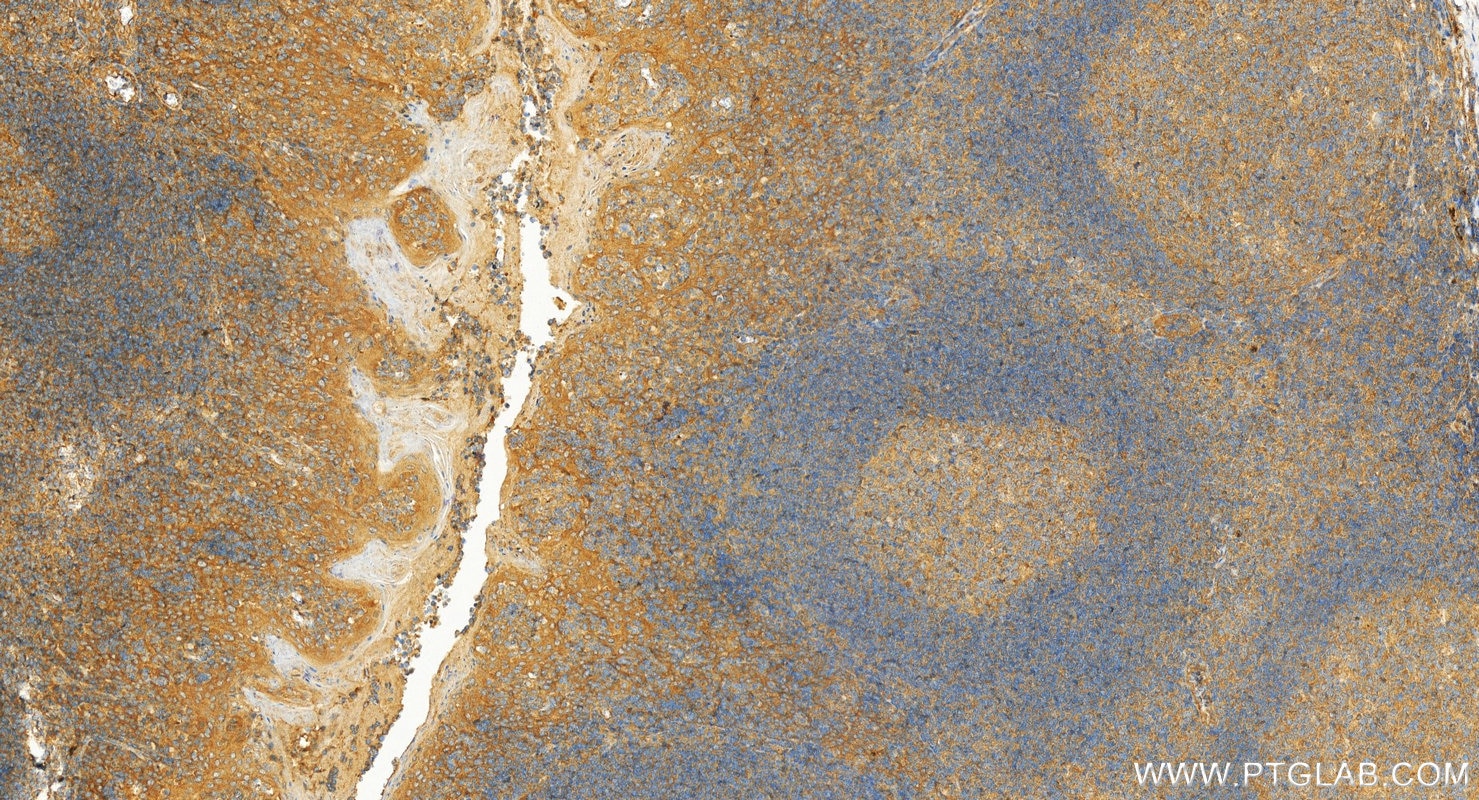 Immunohistochemistry (IHC) staining of human tonsillitis tissue using GM-CSF Polyclonal antibody (17762-1-AP)
