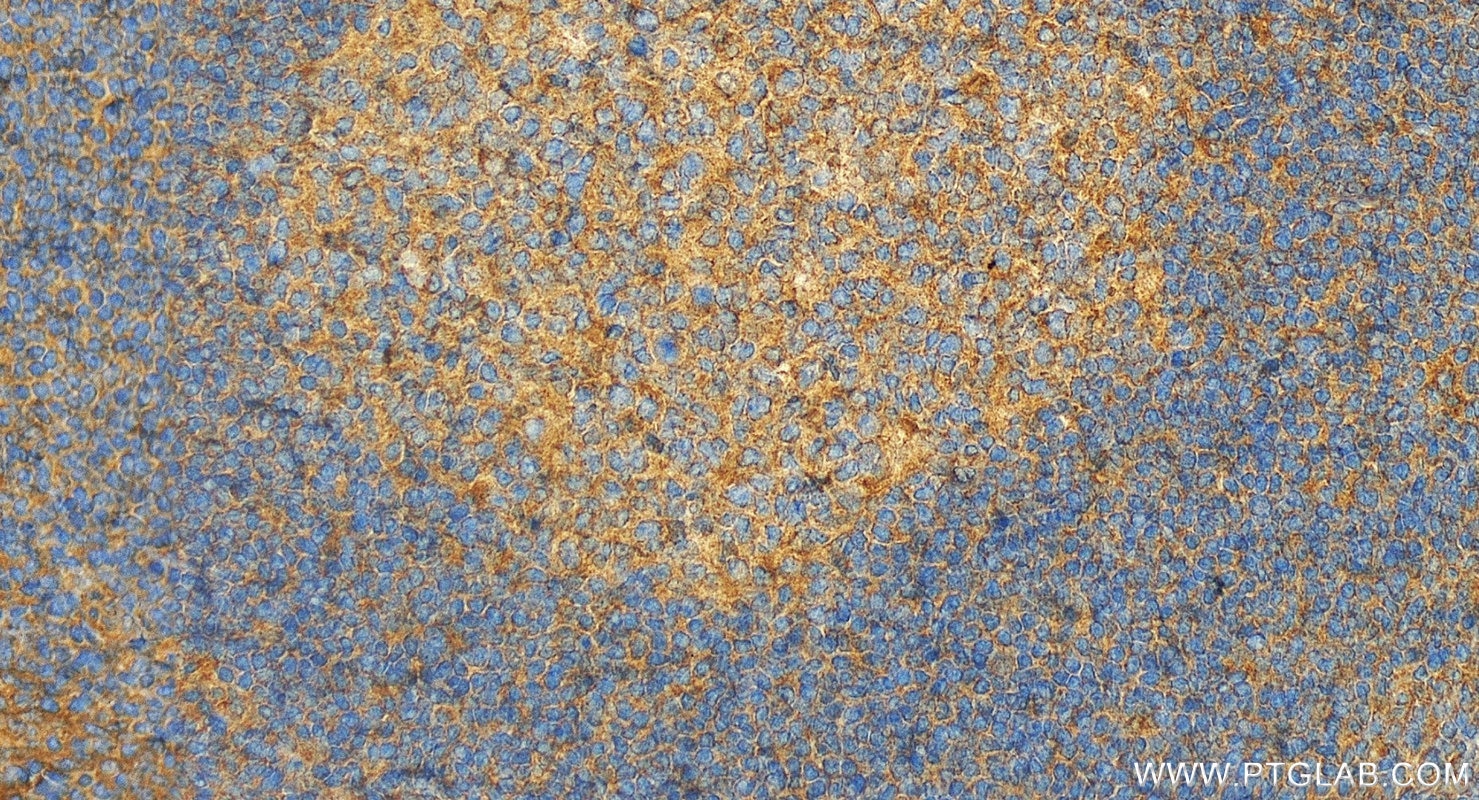 Immunohistochemistry (IHC) staining of human tonsillitis tissue using GM-CSF Polyclonal antibody (17762-1-AP)