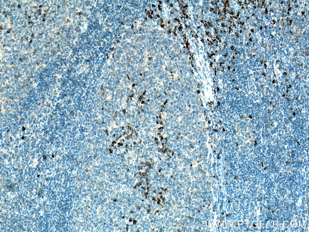 Immunohistochemistry (IHC) staining of human tonsillitis tissue using IL-3RB/CD131 Polyclonal antibody (27148-1-AP)