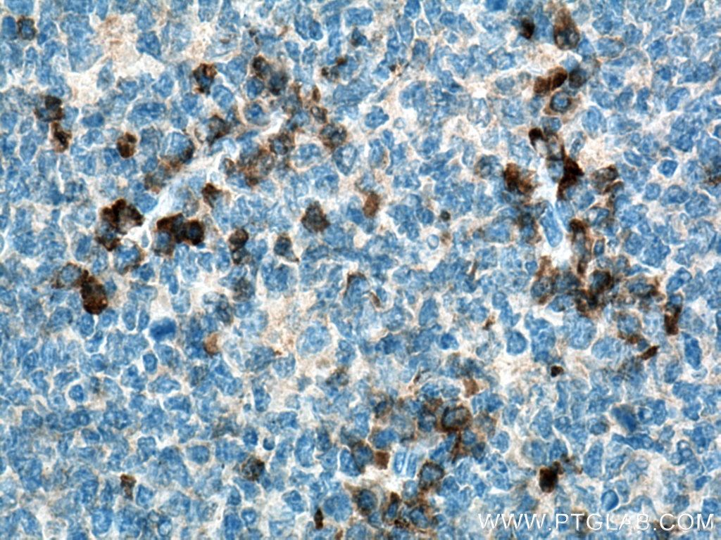 Immunohistochemistry (IHC) staining of human tonsillitis tissue using CSF2RB Polyclonal antibody (27148-1-AP)