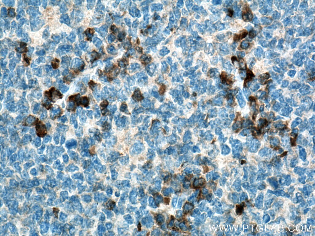 Immunohistochemistry (IHC) staining of human tonsillitis tissue using IL-3RB/CD131 Polyclonal antibody (27148-1-AP)