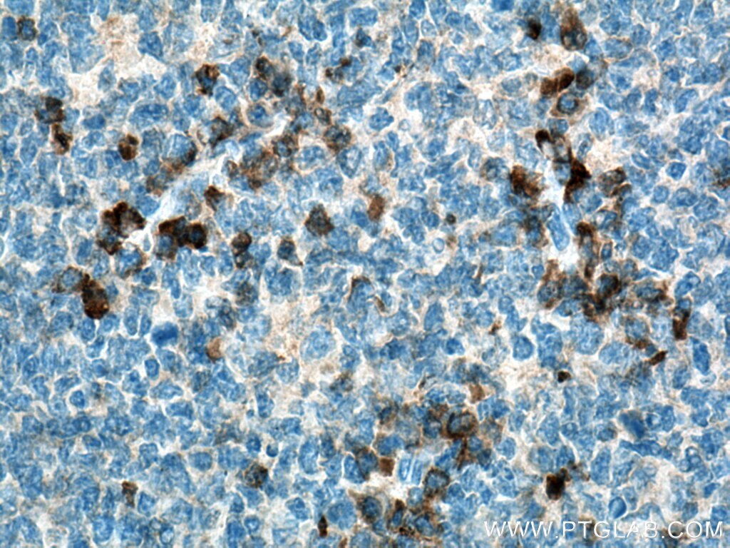 IHC staining of human tonsillitis using 27148-1-AP