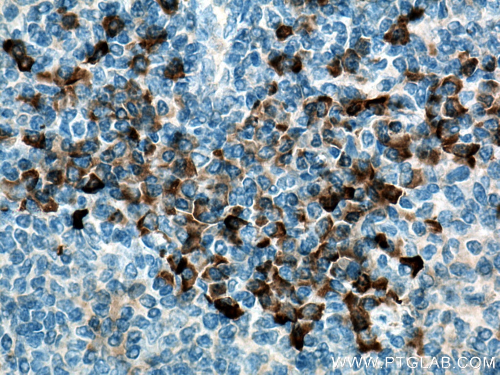 Immunohistochemistry (IHC) staining of human tonsillitis tissue using IL-3RB/CD131 Polyclonal antibody (27148-1-AP)