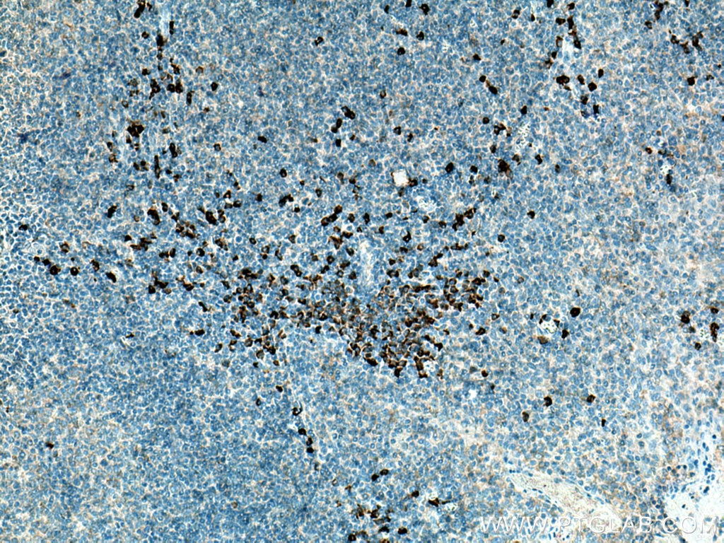 Immunohistochemistry (IHC) staining of human tonsillitis tissue using IL-3RB/CD131 Polyclonal antibody (27148-1-AP)