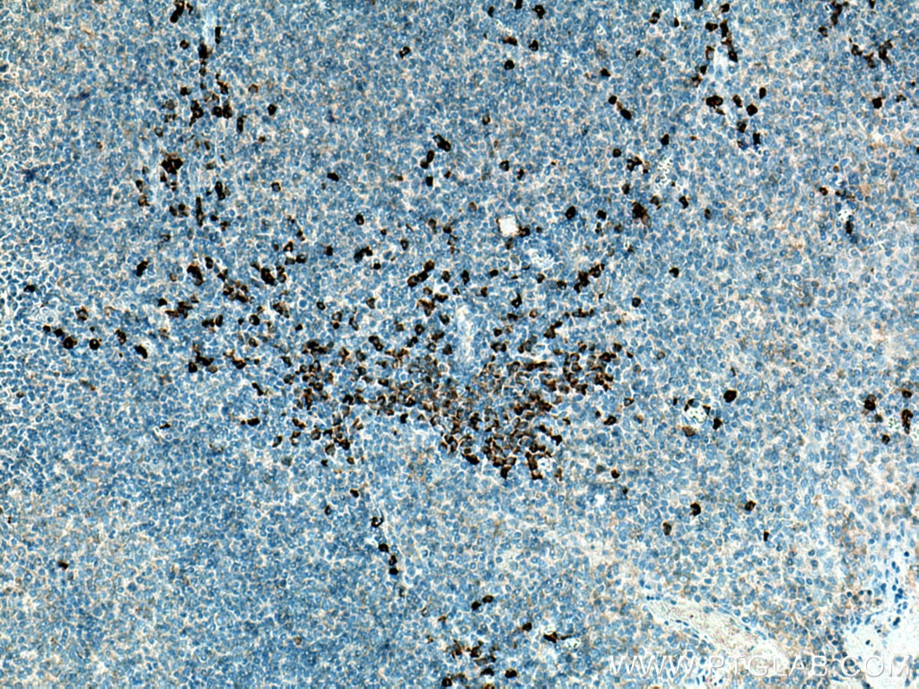 Immunohistochemistry (IHC) staining of human tonsillitis tissue using CSF2RB Polyclonal antibody (27148-1-AP)