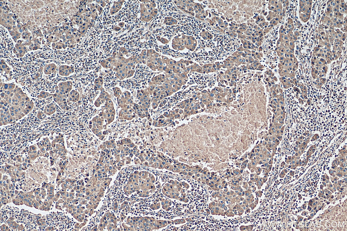 Immunohistochemistry (IHC) staining of human breast cancer tissue using CSN2 Polyclonal antibody (30498-1-AP)