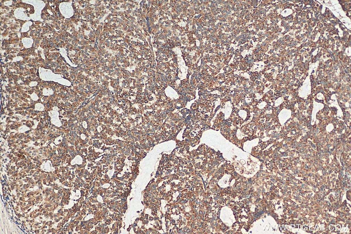 Immunohistochemistry (IHC) staining of human breast hyperplasia tissue using CSN2 Polyclonal antibody (30498-1-AP)