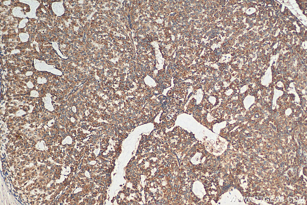 IHC staining of human breast hyperplasia using 30498-1-AP