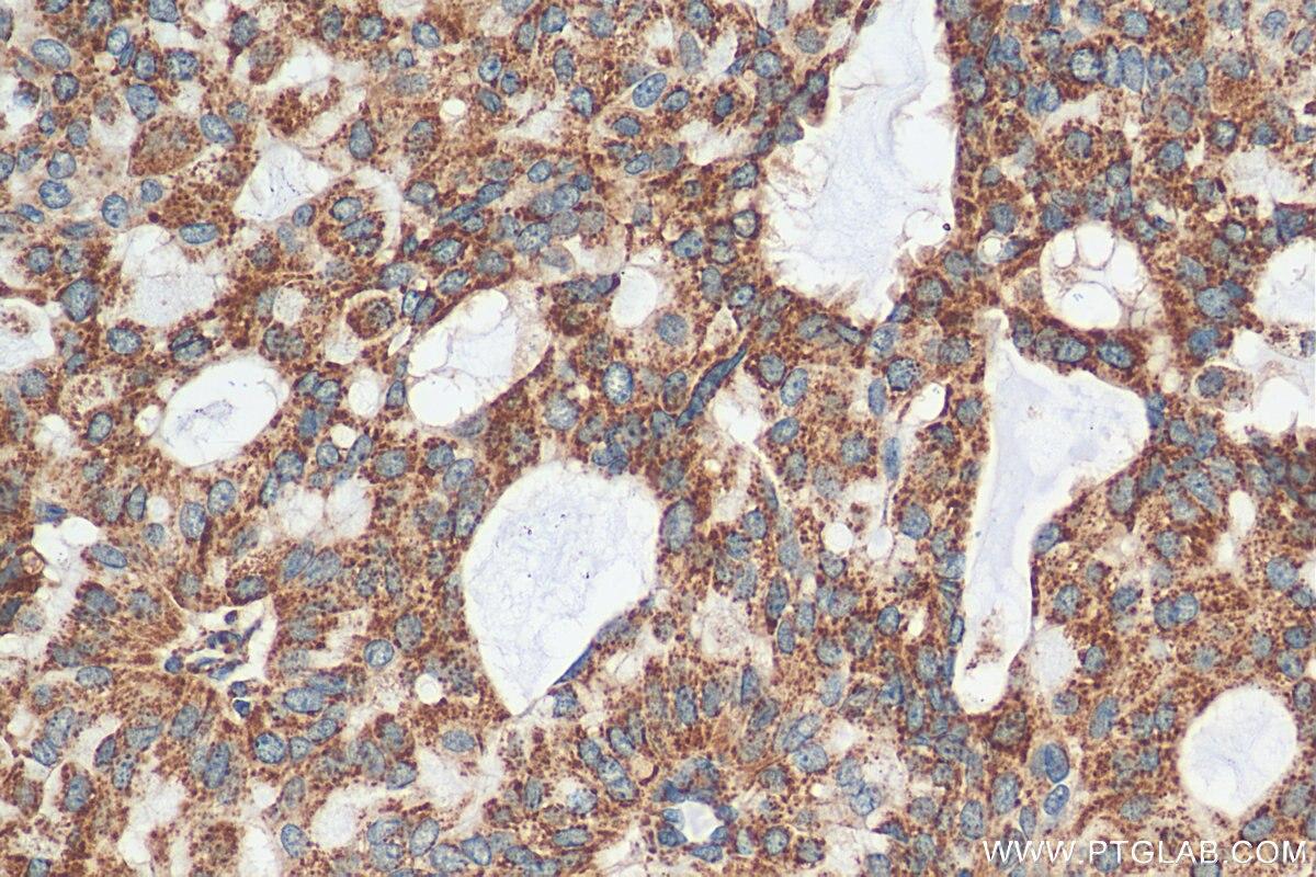 Immunohistochemistry (IHC) staining of human breast hyperplasia tissue using CSN2 Polyclonal antibody (30498-1-AP)