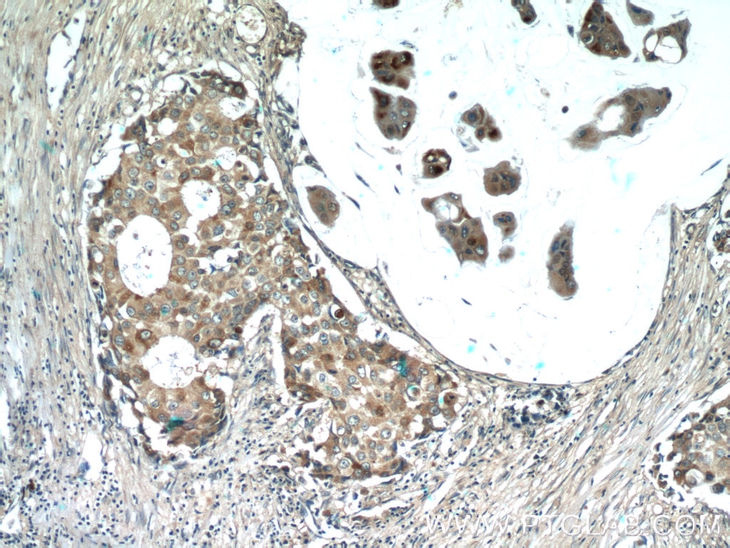 Immunohistochemistry (IHC) staining of human breast cancer tissue using CSN3 Polyclonal antibody (16032-1-AP)