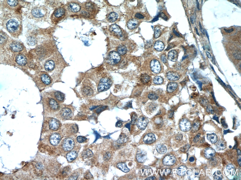 Immunohistochemistry (IHC) staining of human breast cancer tissue using CSN3 Polyclonal antibody (16032-1-AP)