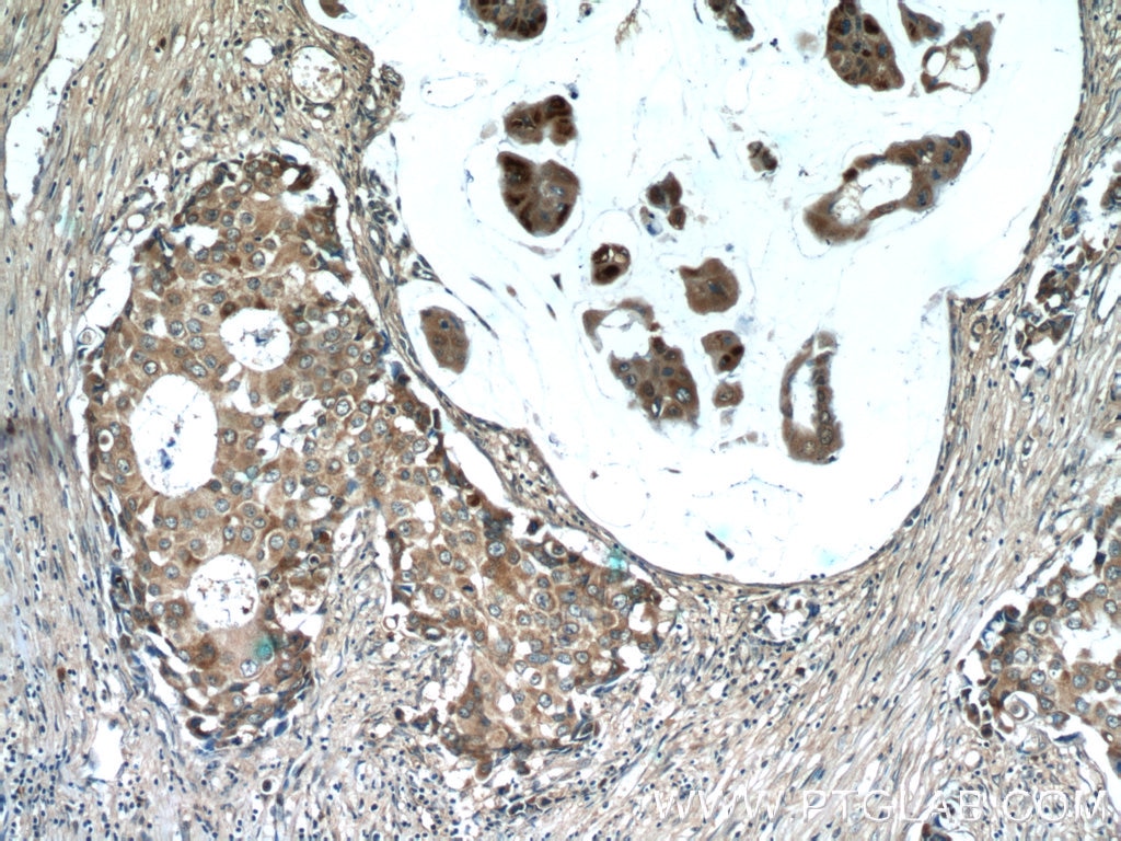 Immunohistochemistry (IHC) staining of human breast cancer tissue using CSN3 Polyclonal antibody (16032-1-AP)