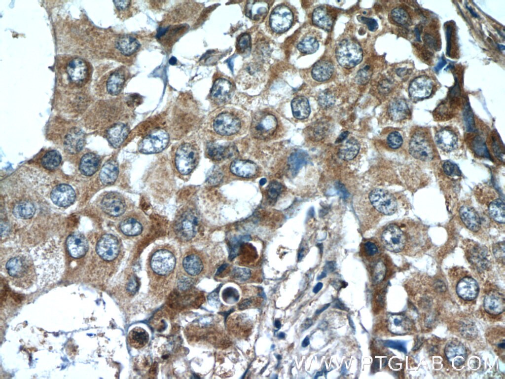 Immunohistochemistry (IHC) staining of human breast cancer tissue using CSN3 Polyclonal antibody (16032-1-AP)