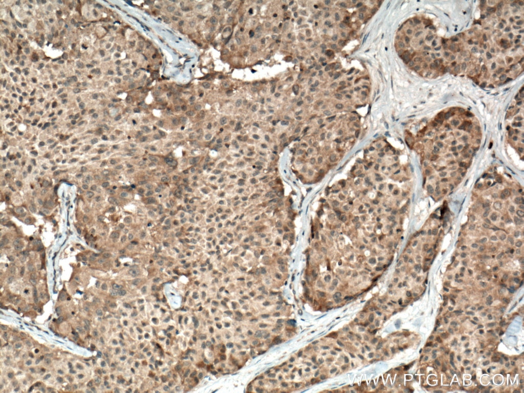 Immunohistochemistry (IHC) staining of human lung cancer tissue using CSNK1A1 Polyclonal antibody (55192-1-AP)