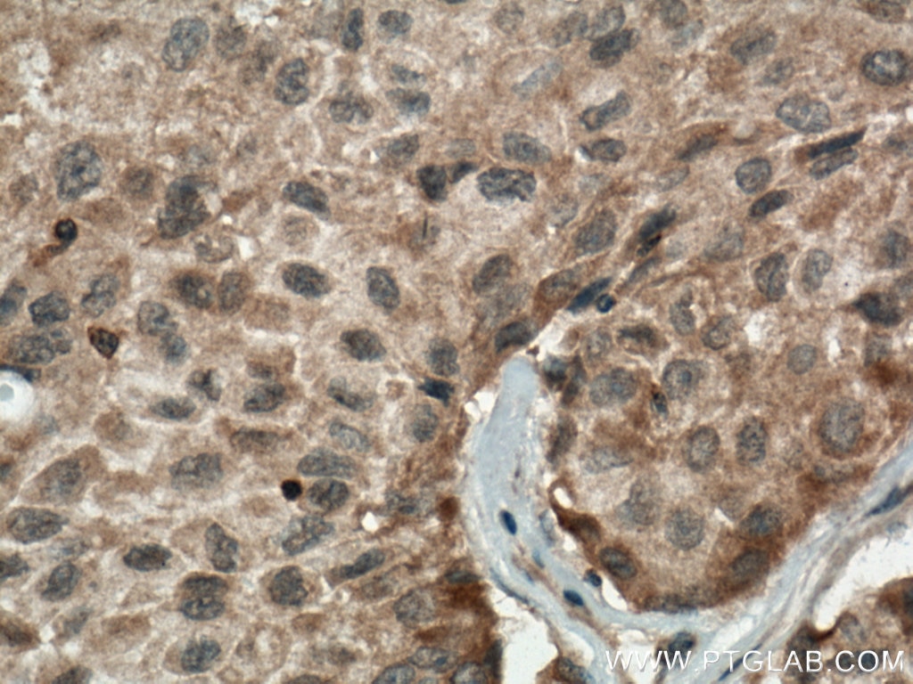 Immunohistochemistry (IHC) staining of human lung cancer tissue using CSNK1A1 Polyclonal antibody (55192-1-AP)