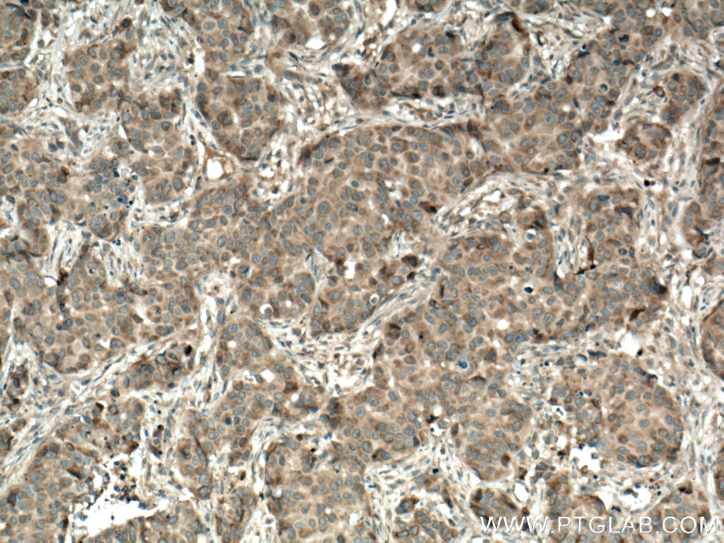 Immunohistochemistry (IHC) staining of human breast cancer tissue using CSNK1A1 Polyclonal antibody (55192-1-AP)