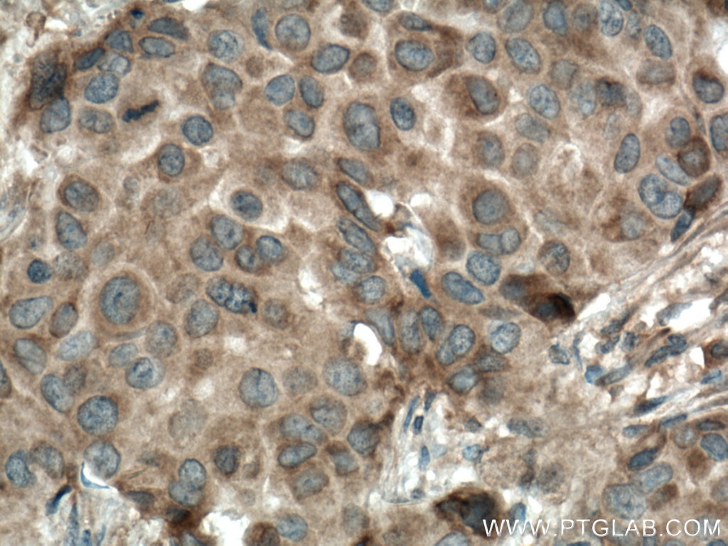 Immunohistochemistry (IHC) staining of human breast cancer tissue using CSNK1A1 Polyclonal antibody (55192-1-AP)