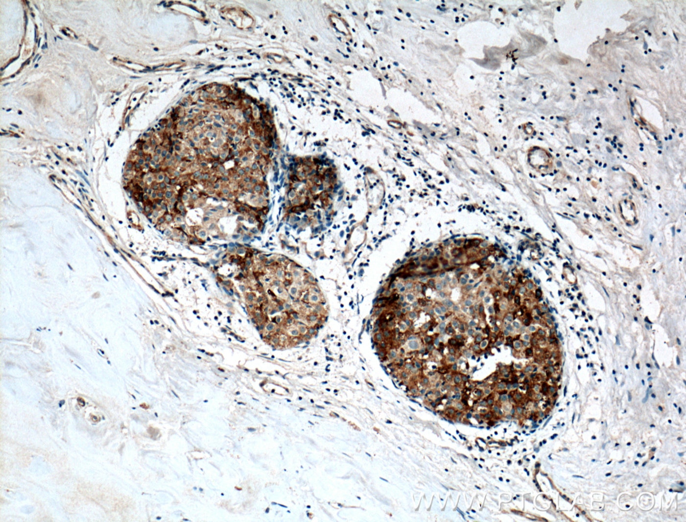 Immunohistochemistry (IHC) staining of human breast cancer tissue using Casein Kinase 1 Epsilon Polyclonal antibody (11230-1-AP)