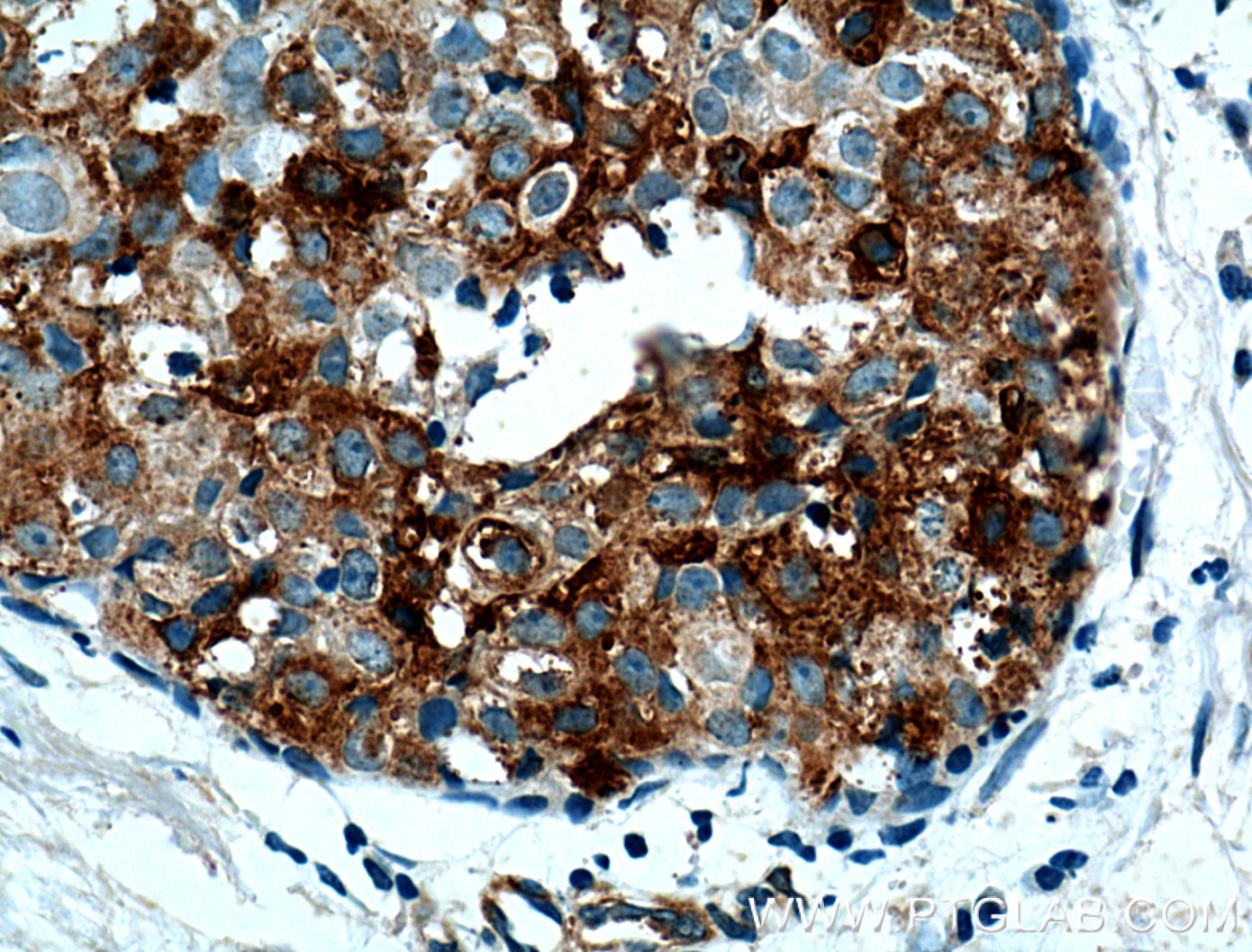 Immunohistochemistry (IHC) staining of human breast cancer tissue using Casein Kinase 1 Epsilon Polyclonal antibody (11230-1-AP)