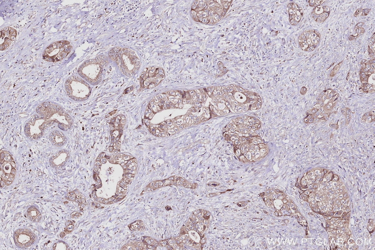 IHC staining of human pancreas cancer using 16384-1-AP Immunohistochemistry (IHC) staining of human pancreas cancer tissue using CSNK1G1 Polyclonal antibody (16384-1-AP)