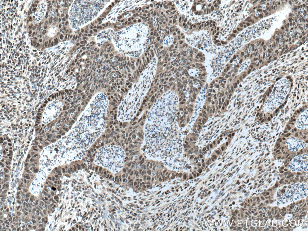 Immunohistochemistry (IHC) staining of human colon cancer tissue using CSNK2A1 Polyclonal antibody (10992-1-AP)