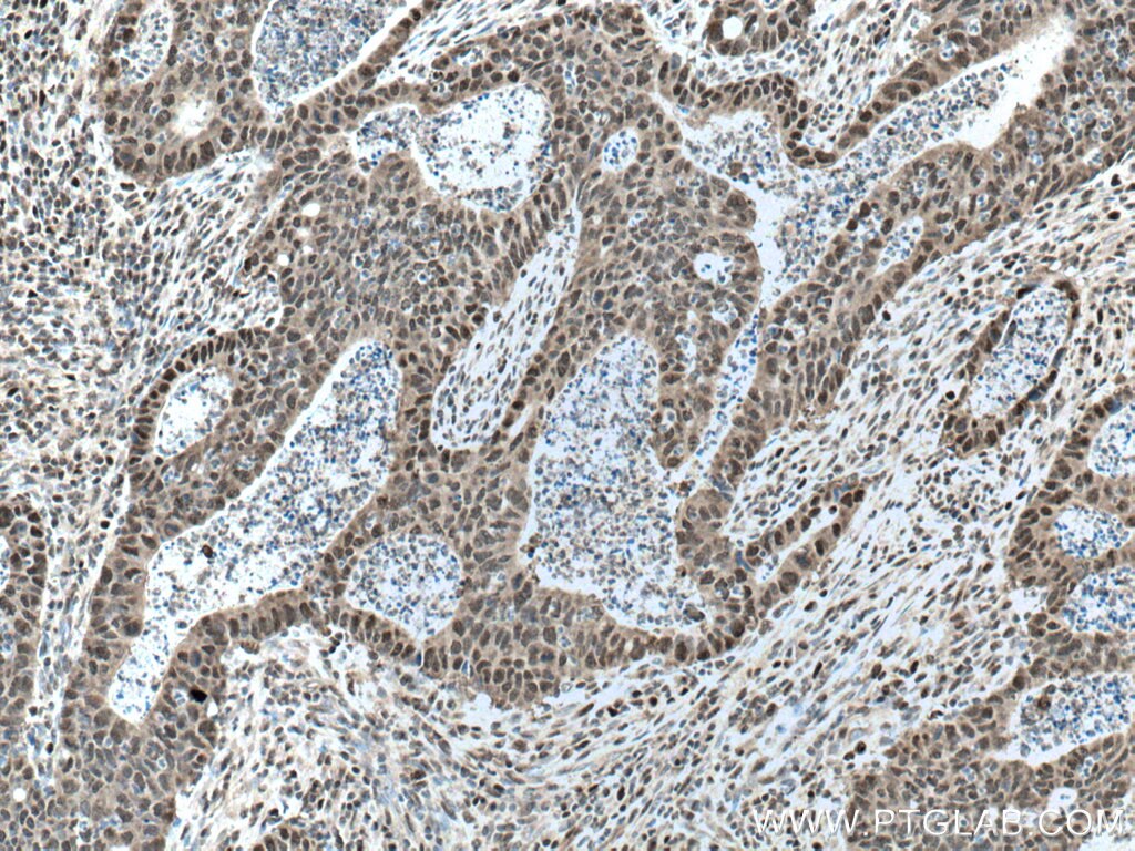 IHC staining of human colon cancer using 10992-1-AP