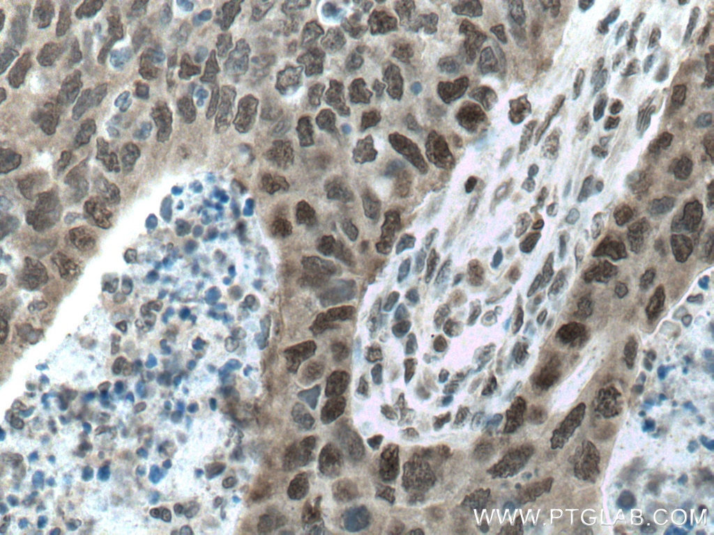 IHC staining of human colon cancer using 10992-1-AP