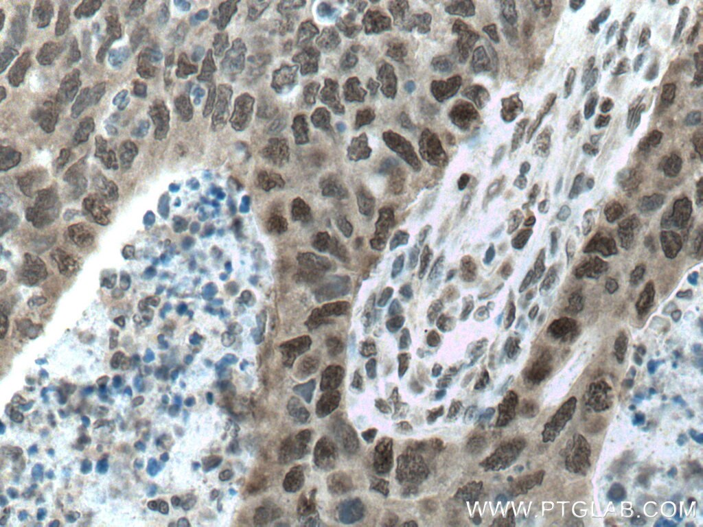 Immunohistochemistry (IHC) staining of human colon cancer tissue using CSNK2A1 Polyclonal antibody (10992-1-AP)