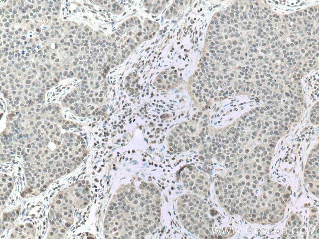 Immunohistochemistry (IHC) staining of human breast cancer tissue using CSNK2A1 Polyclonal antibody (10992-1-AP)