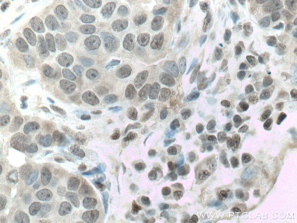 Immunohistochemistry (IHC) staining of human breast cancer tissue using CSNK2A1 Polyclonal antibody (10992-1-AP)
