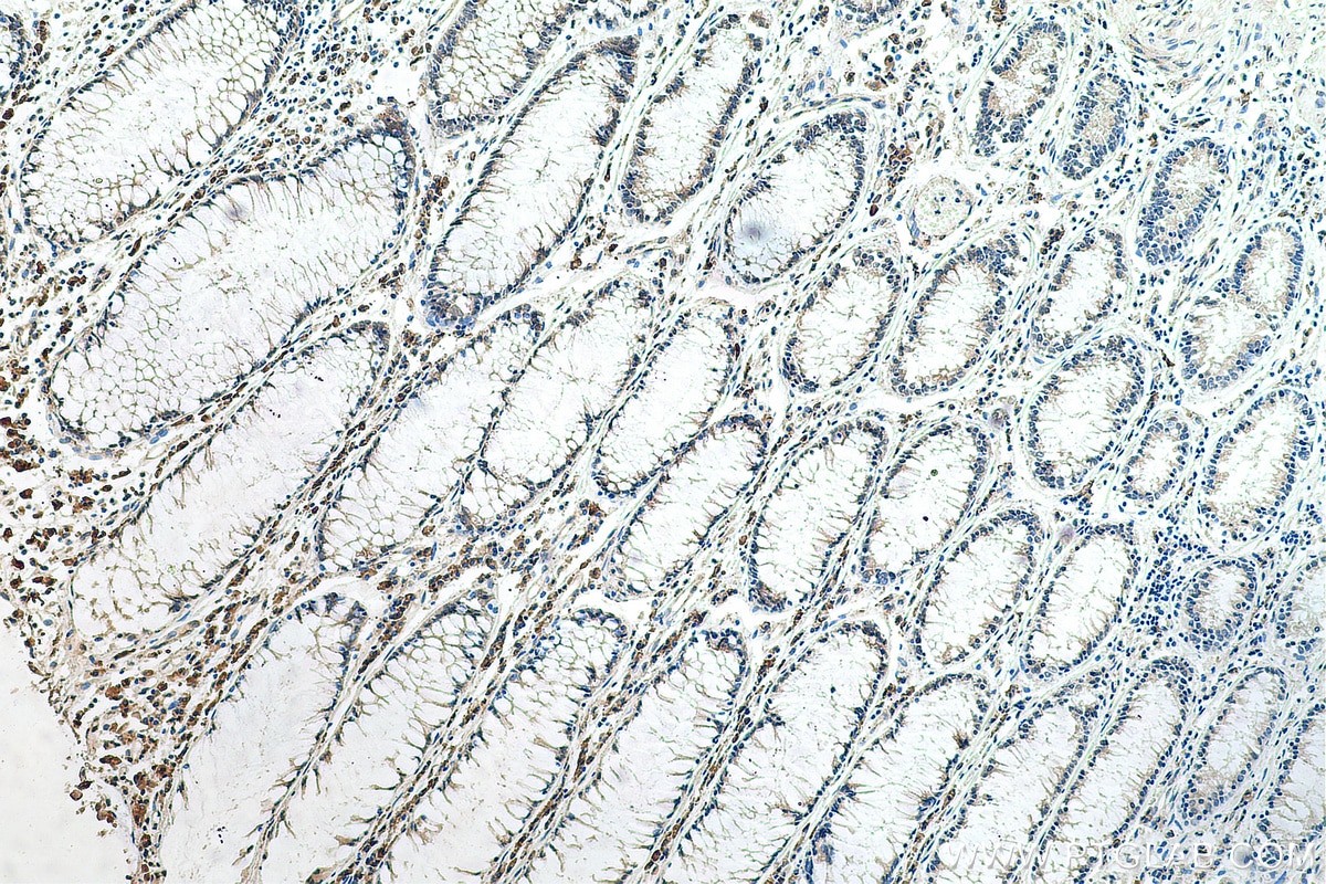 IHC staining of human colon cancer using 67866-1-Ig