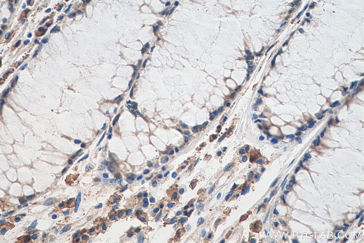 Immunohistochemistry (IHC) staining of human colon cancer tissue using CSNK2B Monoclonal antibody (67866-1-Ig)
