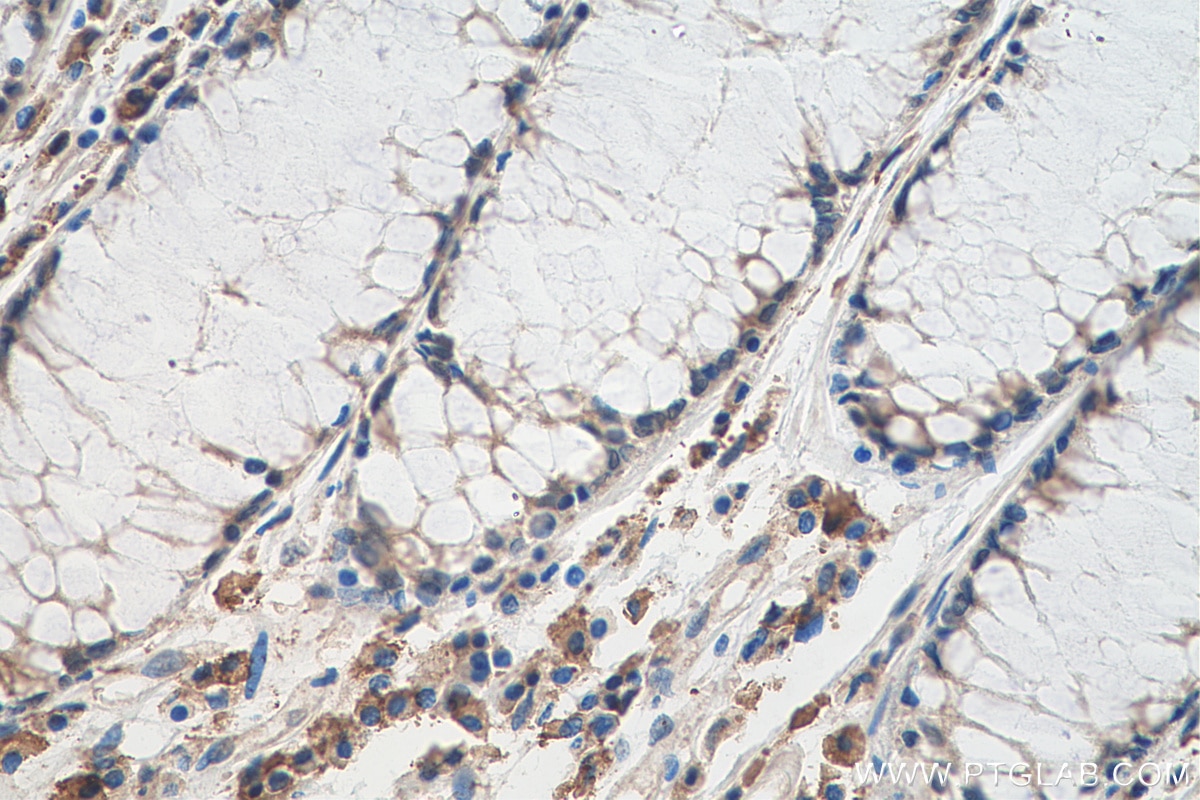 IHC staining of human colon cancer using 67866-1-Ig