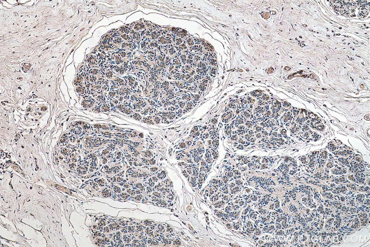 IHC staining of human breast cancer using 67866-1-Ig