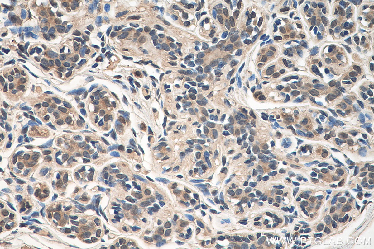 Immunohistochemistry (IHC) staining of human breast cancer tissue using CSNK2B Monoclonal antibody (67866-1-Ig)