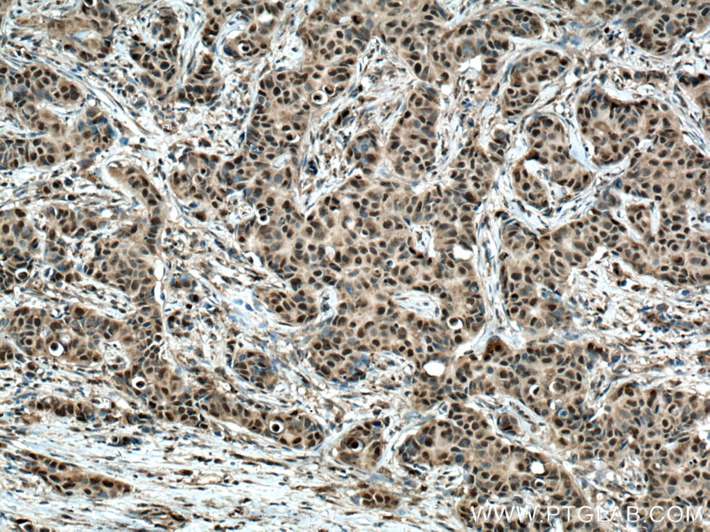 Immunohistochemistry (IHC) staining of human breast cancer tissue using CSNK2B-specific Polyclonal antibody (20234-1-AP)