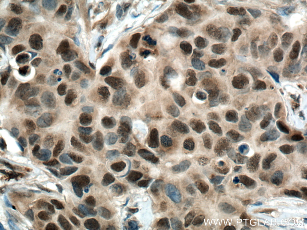 Immunohistochemistry (IHC) staining of human breast cancer tissue using CSNK2B-specific Polyclonal antibody (20234-1-AP)