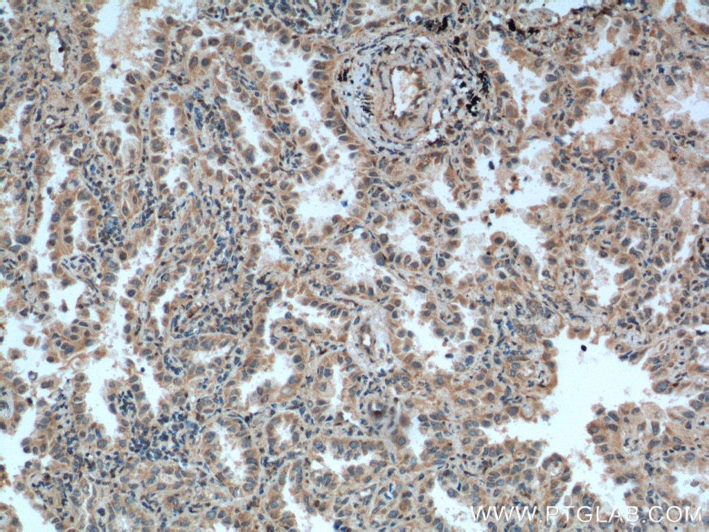 Immunohistochemistry (IHC) staining of human lung cancer tissue using CSRP1 Polyclonal antibody (13432-1-AP)