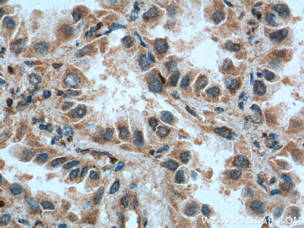 Immunohistochemistry (IHC) staining of human lung cancer tissue using CSRP1 Polyclonal antibody (13432-1-AP)