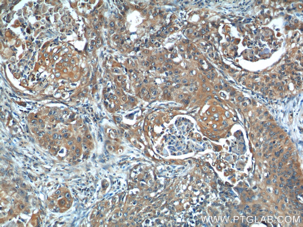 Immunohistochemistry (IHC) staining of human lung cancer tissue using CSRP1 Polyclonal antibody (13432-1-AP)