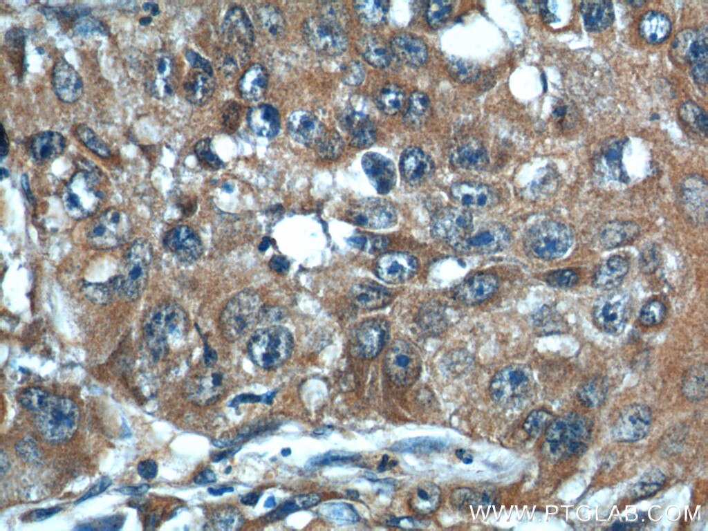 Immunohistochemistry (IHC) staining of human lung cancer tissue using CSRP1 Polyclonal antibody (13432-1-AP)