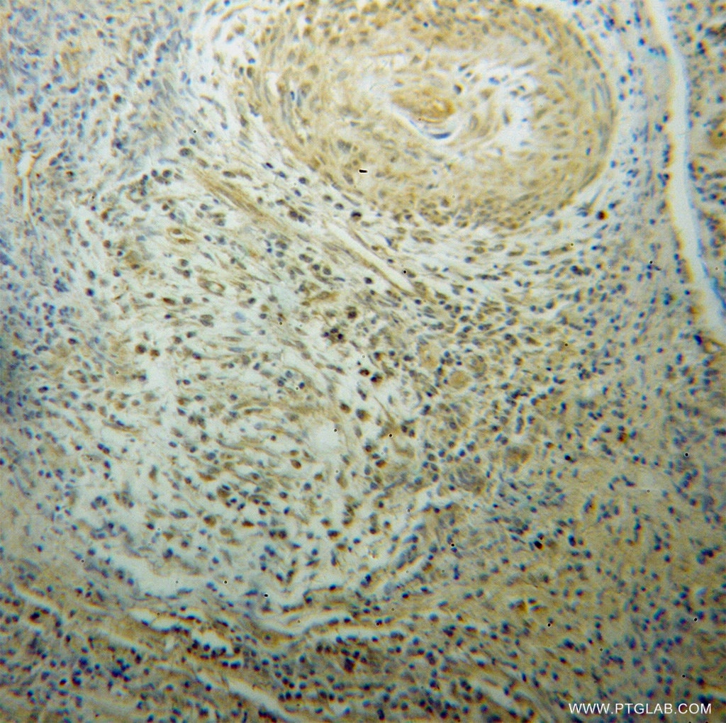 Immunohistochemistry (IHC) staining of human cervical cancer tissue using CSRP1 Polyclonal antibody (13432-1-AP)