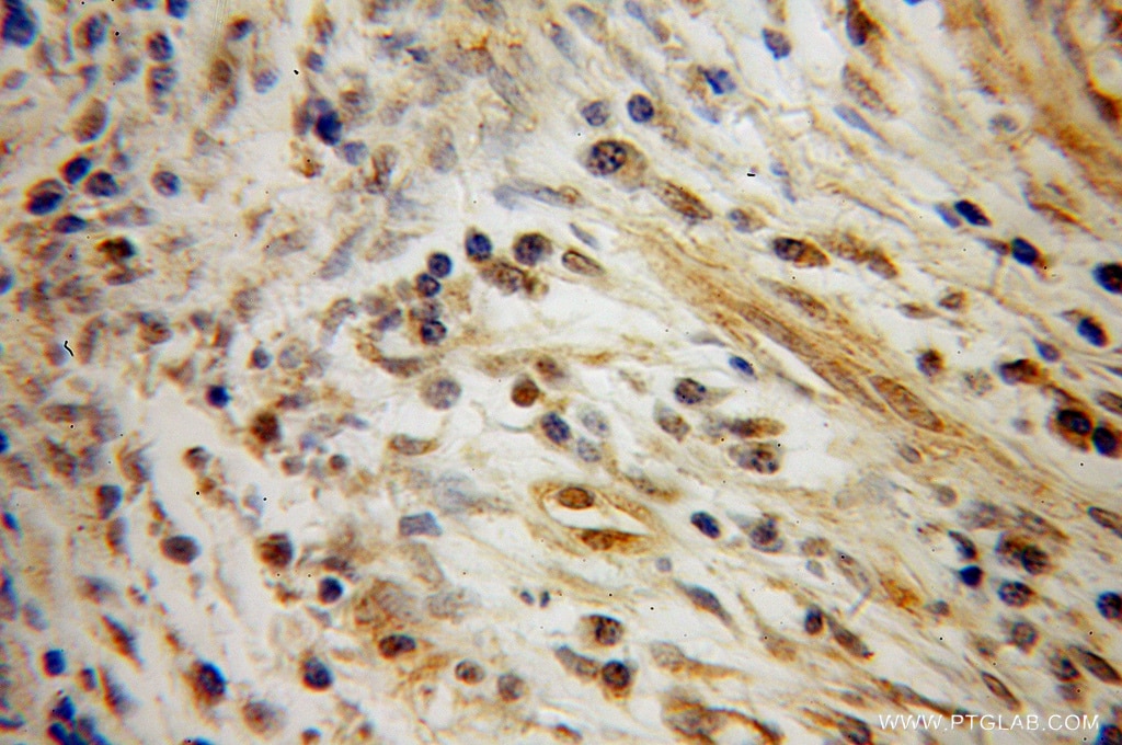 Immunohistochemistry (IHC) staining of human cervical cancer tissue using CSRP1 Polyclonal antibody (13432-1-AP)