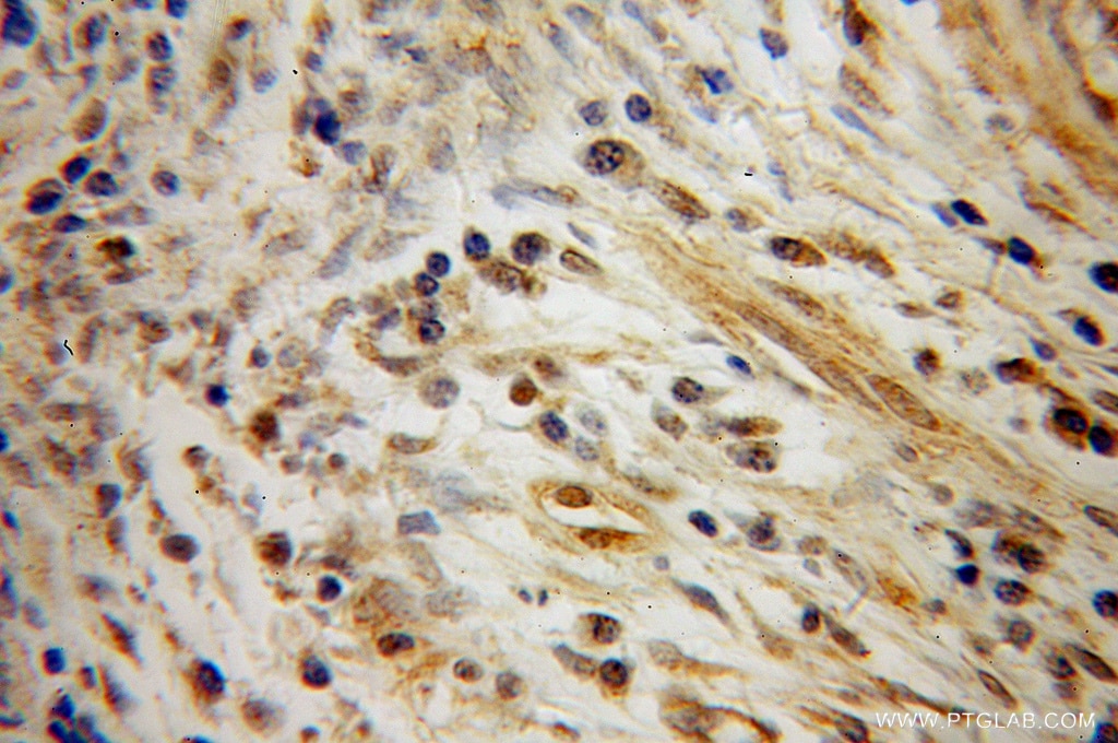 IHC staining of human cervical cancer using 13432-1-AP