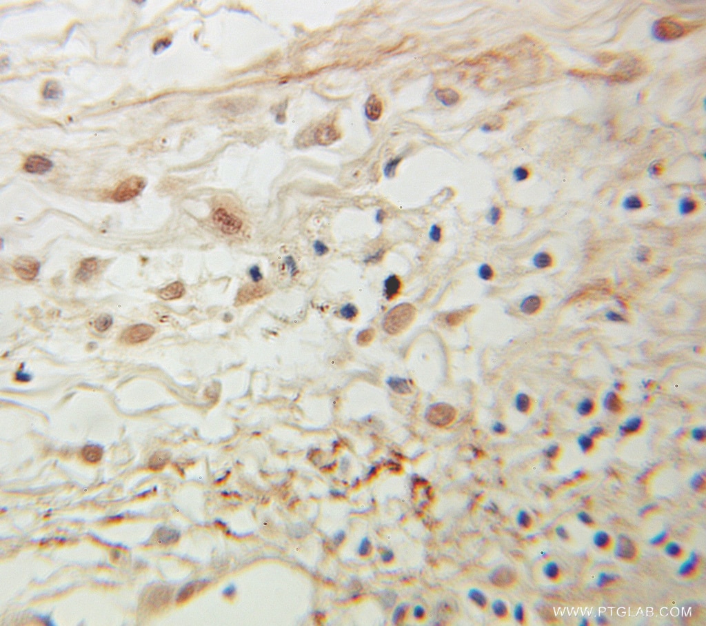 Immunohistochemistry (IHC) staining of human pancreas cancer tissue using CSRP3 Polyclonal antibody (10721-1-AP)
