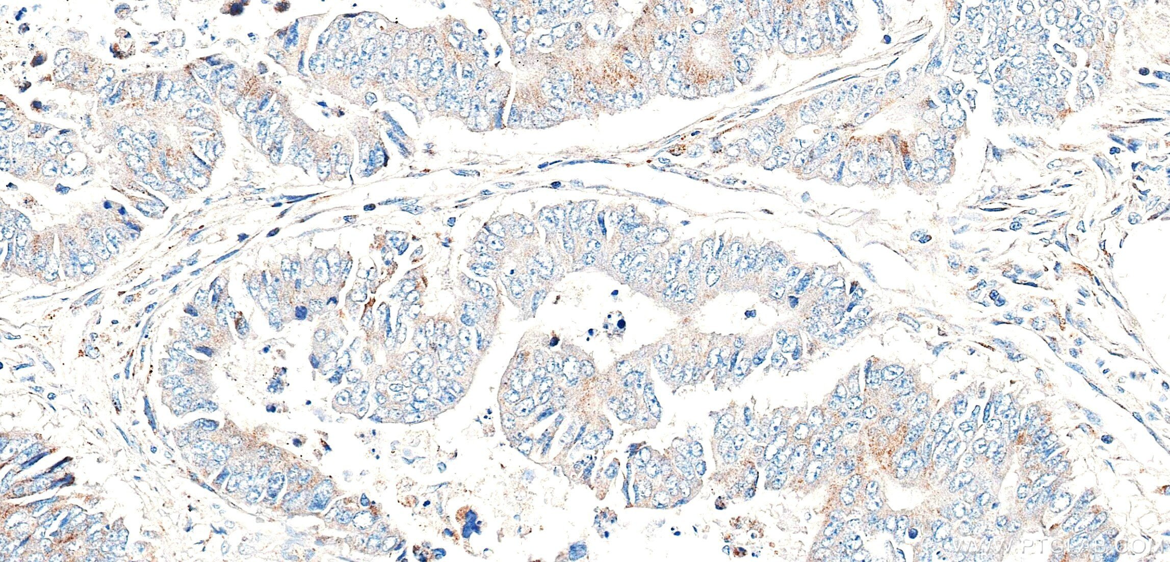 Immunohistochemistry (IHC) staining of human colon cancer tissue using CST2 Recombinant monoclonal antibody (86701-1-RR)
